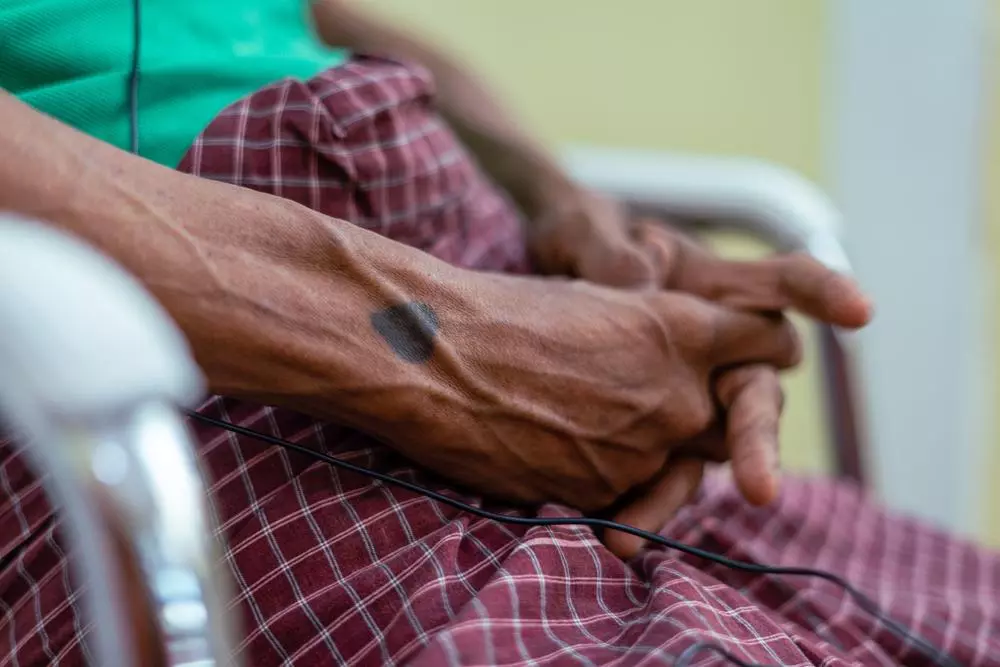 Heart tattoo inked on the hands of an HIV/hepatitis C co-infected patient during an interview with MSF. 