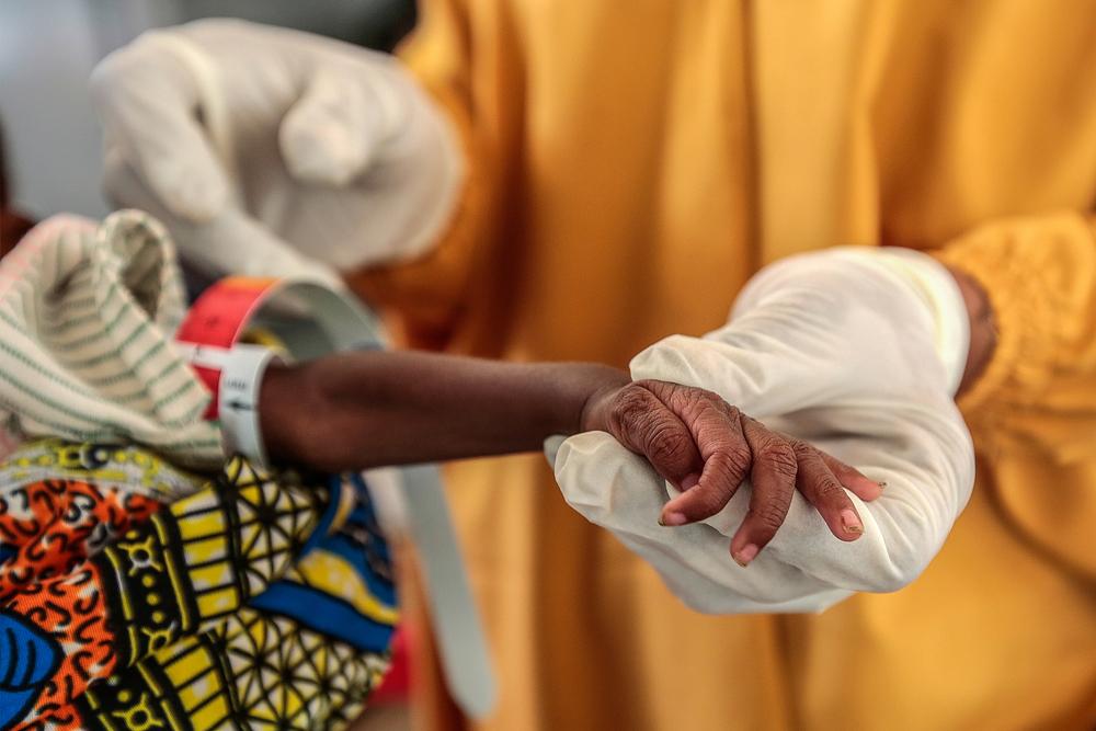 MSF medical staff measuring brachial circumference of a severely malnourished child at the MSF Kofar Marusa ambulatory therapeutic feeding centre, Nigeria. © George Osodi