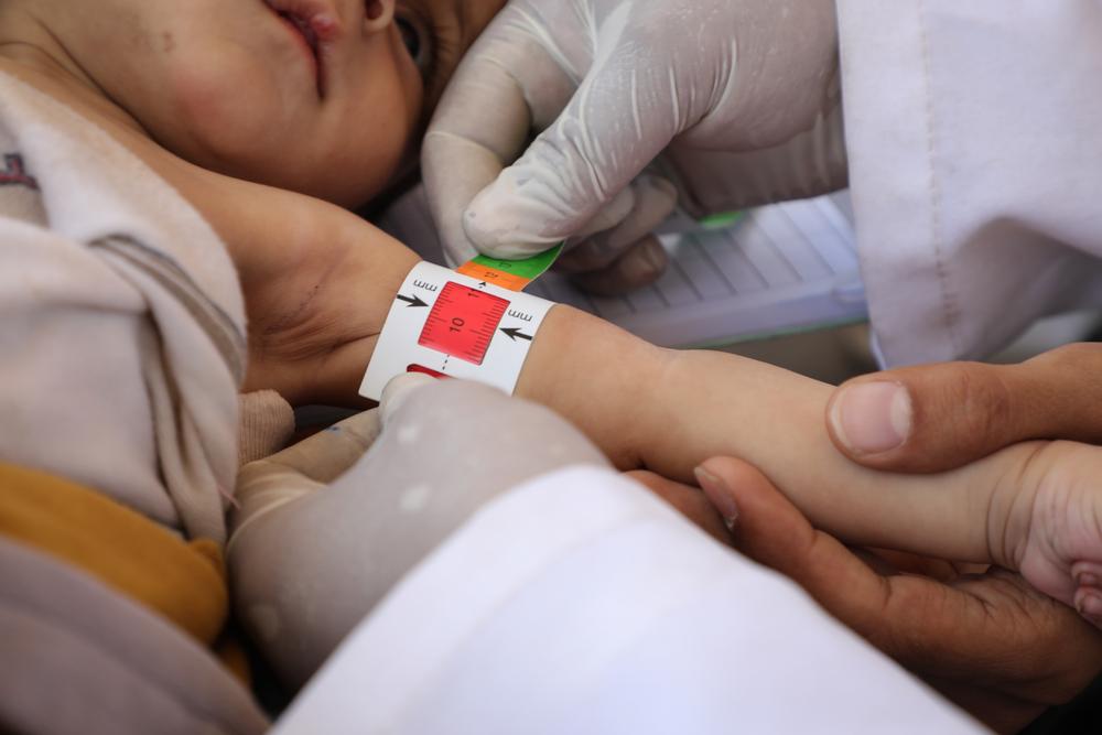 A child was diagnosed with severe acute malnutrition during the consultations provided by the team at the mobile clinic in Qarn Al Asad area in Rada’a, Al Bayda Governorate. Malnourished children are more susceptible to measles. Yemen, June 2023. © Aljunaid/MSF