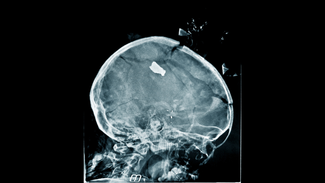 A skull X-ray of a child patient showing shrapnel