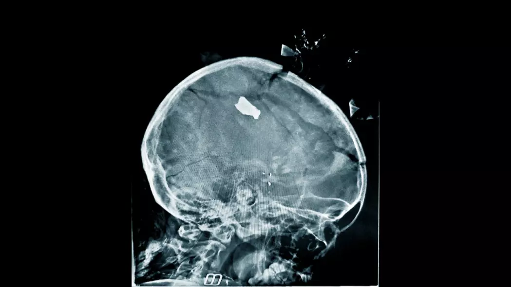A skull X-ray of a child patient showing shrapnel