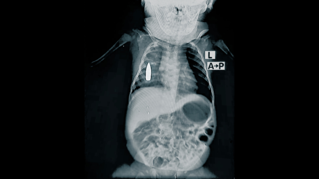 X-ray an 18-month-old toddler who was struck in the chest by a stray bullet while he was taking a nap in Khartoum.