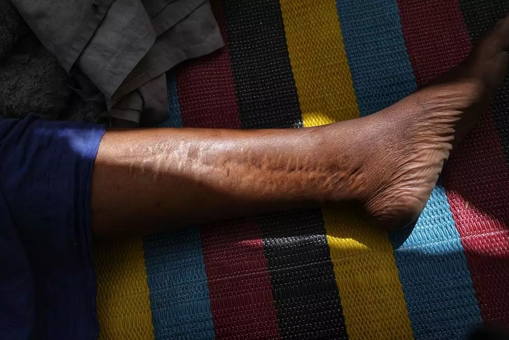 The scar of a patient whose leg was hit by a bullet during crossfire and battle.