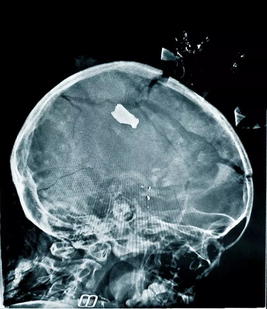 X-Ray of a child 
