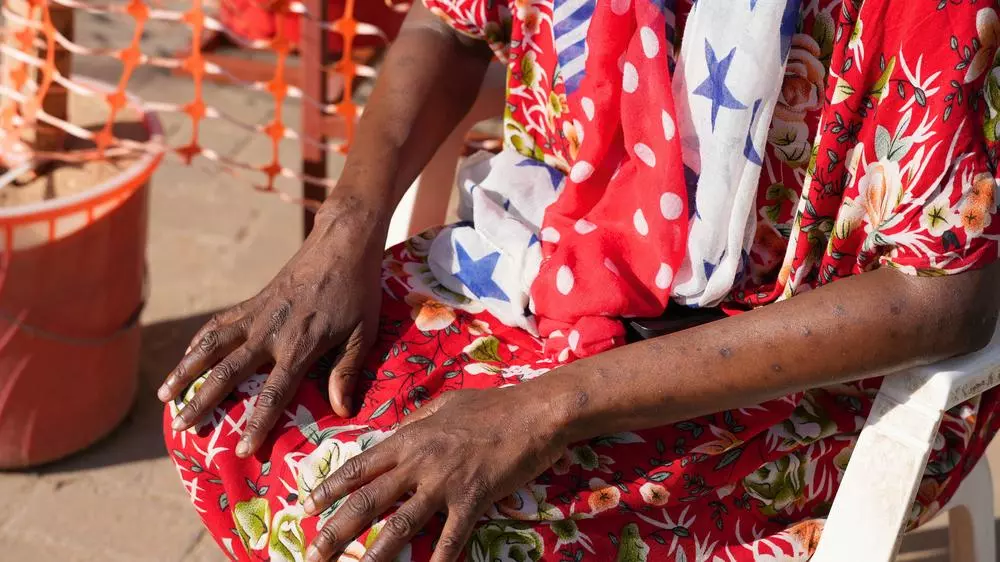 A patient shows the scars following her successful treatment for mpox