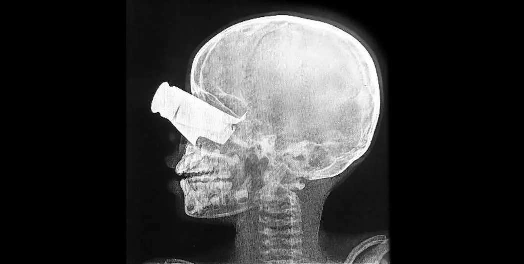 X-ray of a child's injury